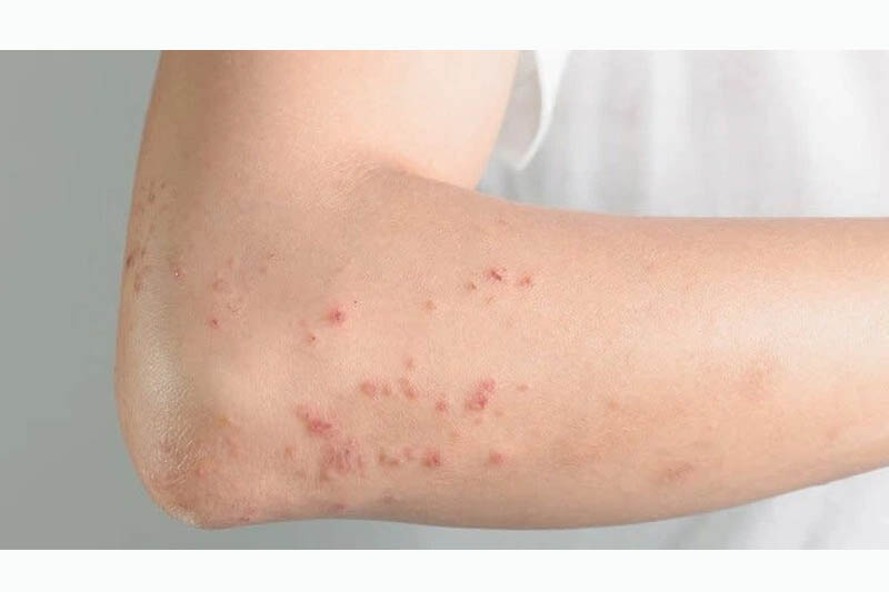 Bị dị ứng thức ăn bao lâu thì hết?