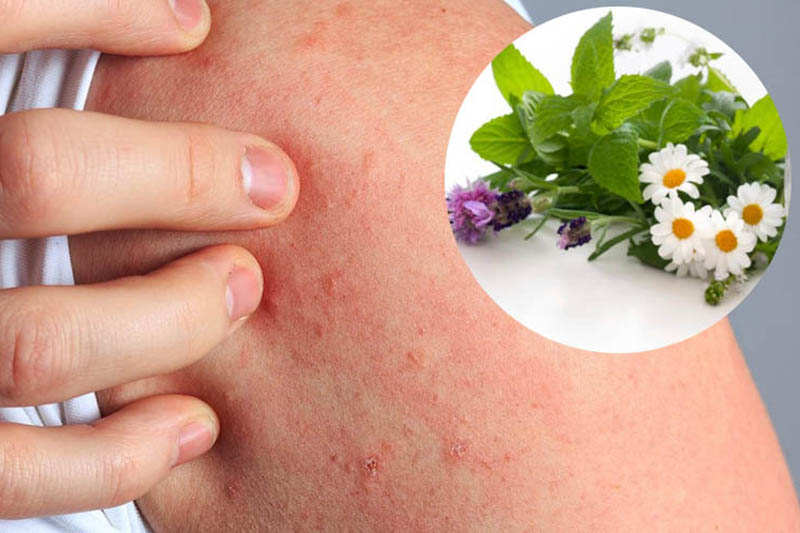Mẹo chữa dị ứng mẩn ngứa bằng cách nào?