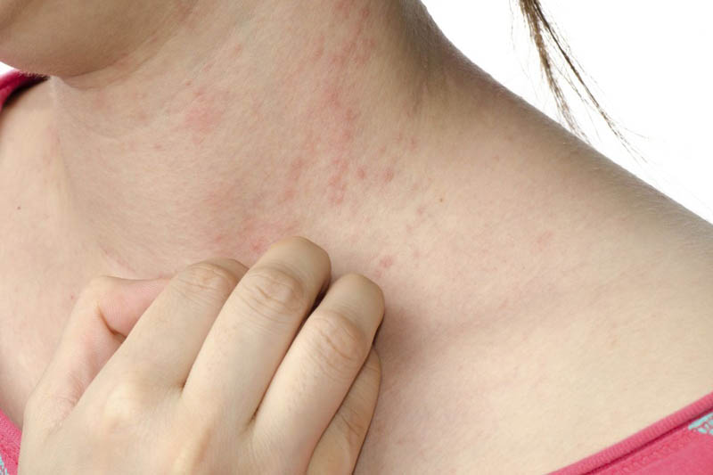 Hay bị dị ứng là thiếu chất gì?
