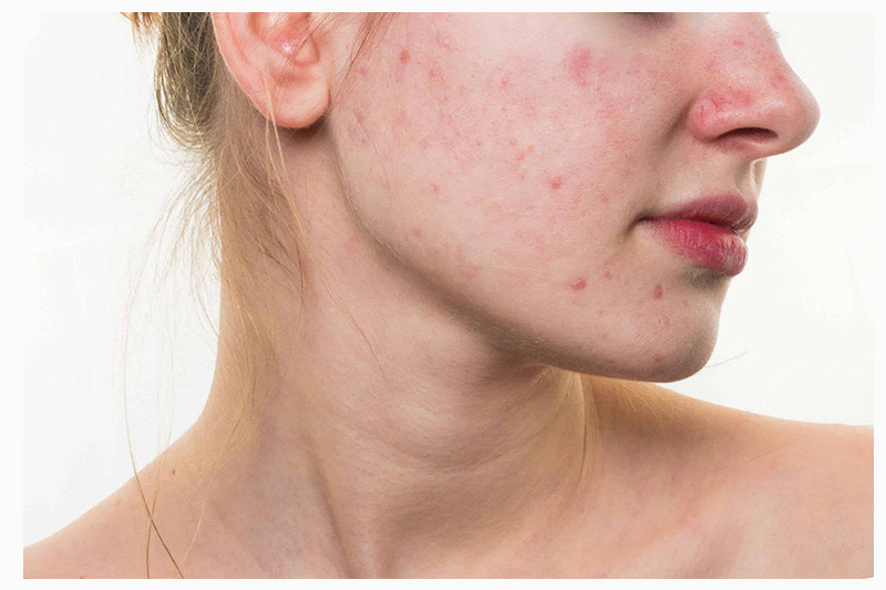 Dị ứng có tự hết không?