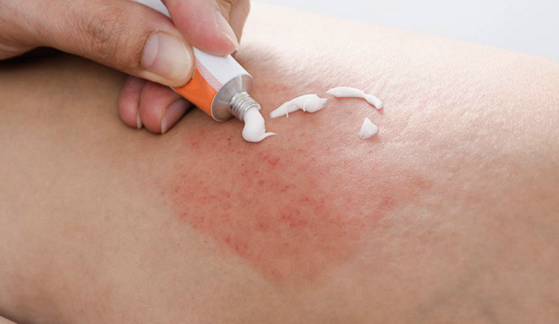 Dị ứng lâu ngày không khỏi, phải làm sao?