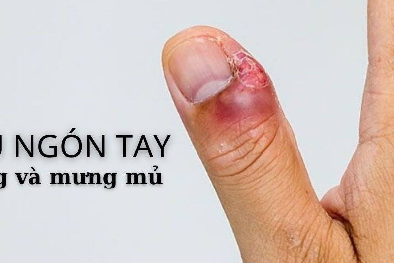 Sưng đau đau ngón tay cái, phải làm sao?