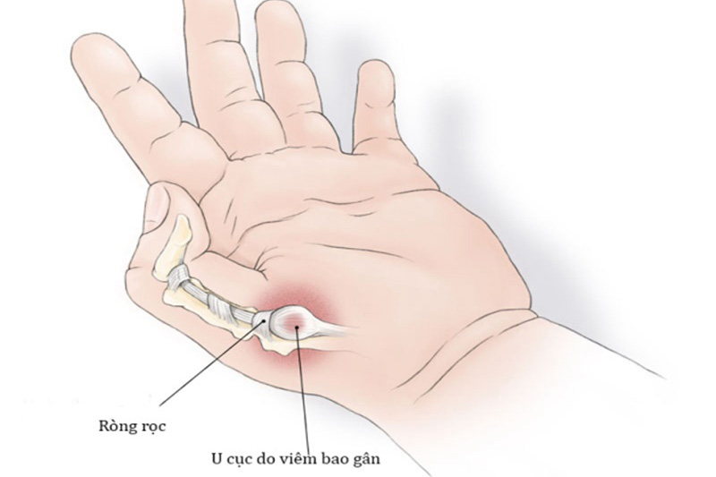 Hiện tượng đau ngón tay cái do đâu? Cách điều trị